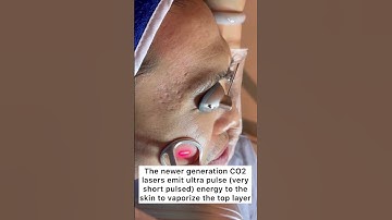 Thumbnail of CO2 Fractional Laser Resurfacing for Acne Scars #shorts