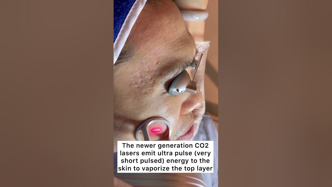 CO2 Fractional Laser Resurfacing for Acne Scars #shorts