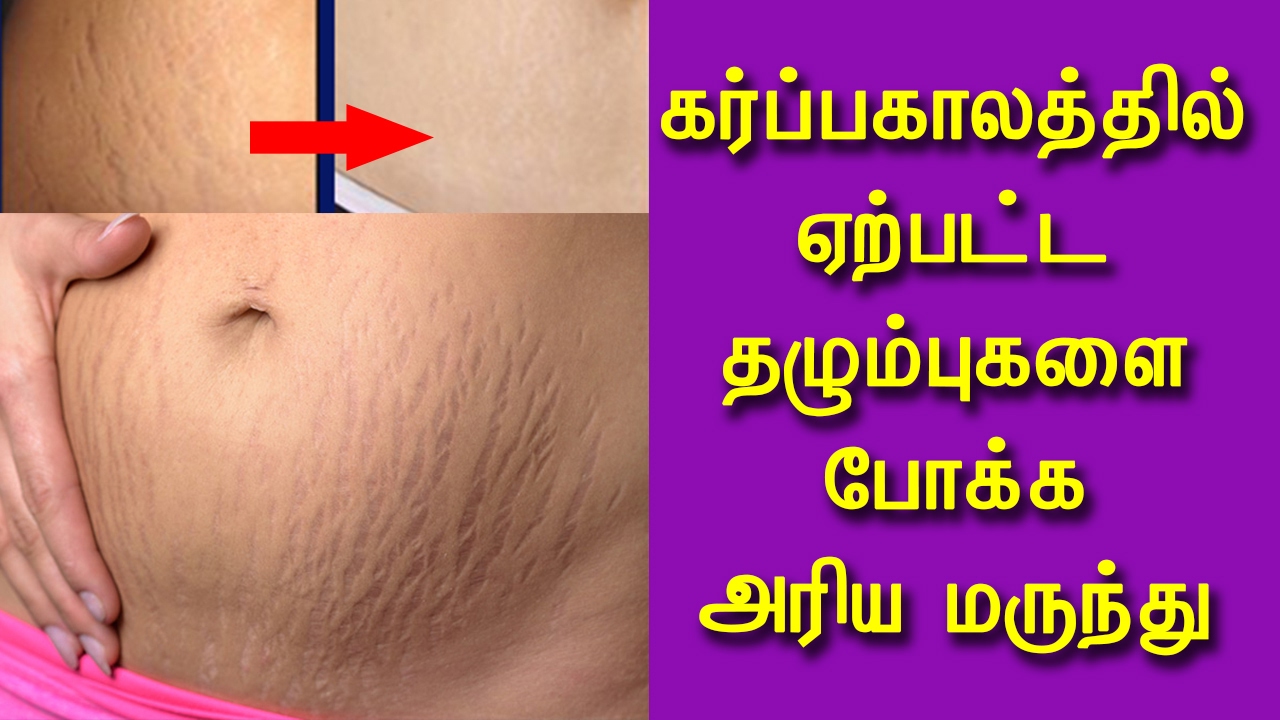 How To Get Rid of Stretch Marks With Aloe Vera in Tamil - Beauty Tips in Tamil - YouTube
