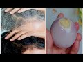 White Hair Turn To Black Hair Naturally Permanently with Onion - Get rid gray hair permanent ผมหงอก