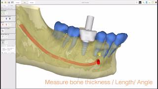 AxisGuide® Plan: Implant Planning software FREE.