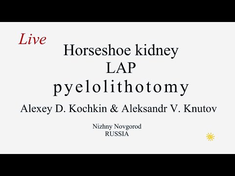 HSK Lap pyelolithotomy/пиелолитотомия/подковообразная почка/Живая хирургия/Кочкин