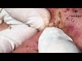 Blackheads not popping but insertion     