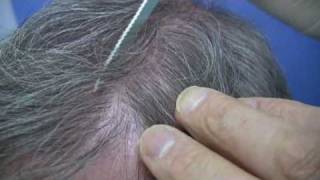 Doctor Wong Hair Transplant - 4812 Grafts - Session