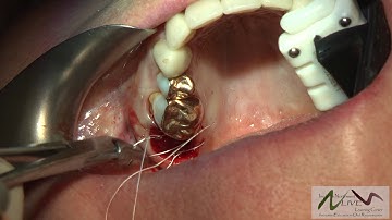 Minimally Invasive Socket Preservation with BioXclude Amnion Chorion Membrane