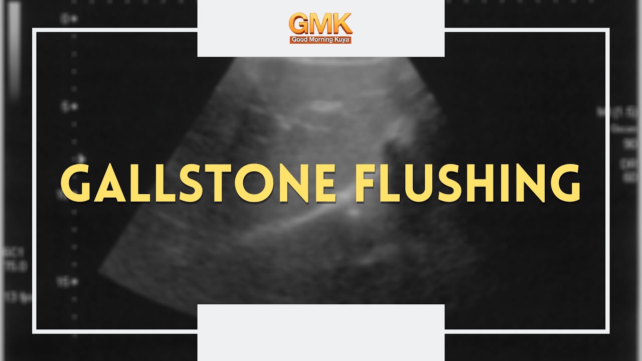Gallstone Flushing (PART 1) Usapang Pangkalusugan YouTube