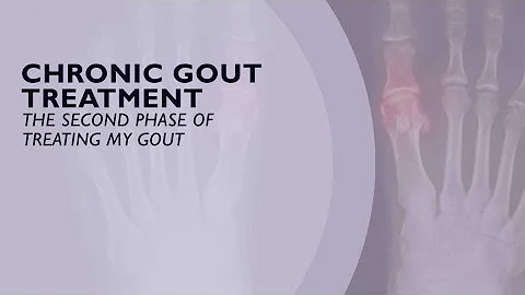 Chronic Gout Treatment - The Second Phase of Treating Gout (6 of 6) - DayDayNews