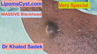 7 year Great Blackhead. Dr Khaled Sadek LipomaCyst.com screenshot 2