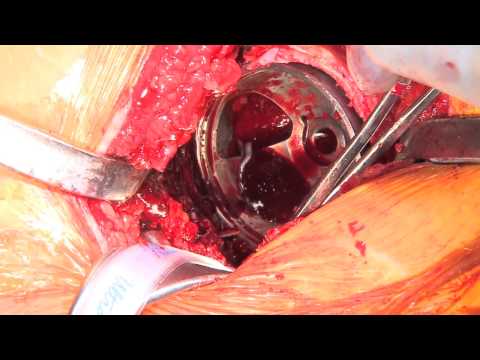 TJO Klassic HD® Hip System Surgical Video