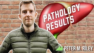 PATHOLOGY RESULTS from my liver resection