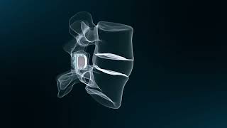 SC Medica: FFX Lumbar Facet FiXation
