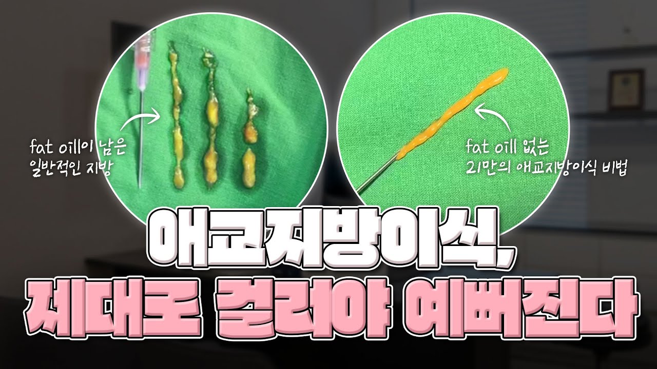 애교지방이식, 제대로 걸러야 예뻐진다