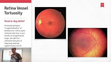 BDP12 - Retina Vessel Tortuosity