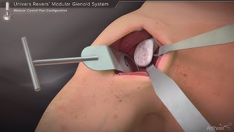 Univers Revers™ Modular Glenoid System - Modular Center Post Configuration