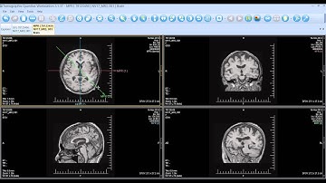 Quantiva | MPR - Multiplanar Reconstruction
