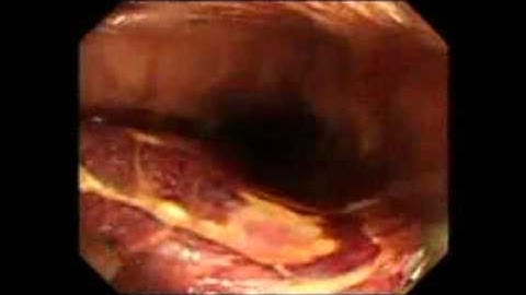 ASGE Learning Video Sample - Endoscopic Treatments in Barrett