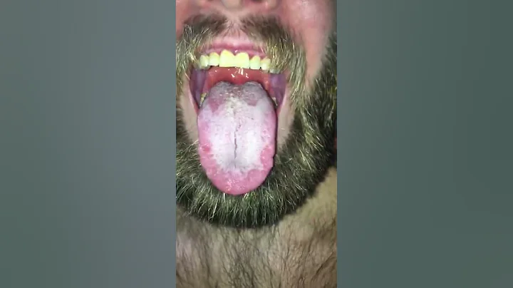 Swallowing his tongue part 1