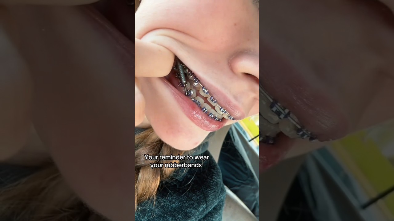 If you wearing braces, better wear your rubber bands or you get this... 