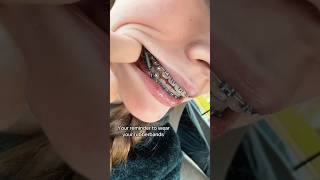 Download Lagu If you wearing braces, better wear your rubber bands or you get this... #braces #orthodontics #girl MP3