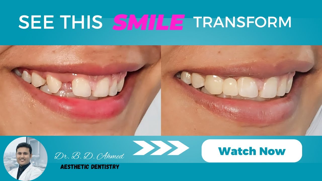 Smile transformation. Dental Zirconia bridge procedure 🌉