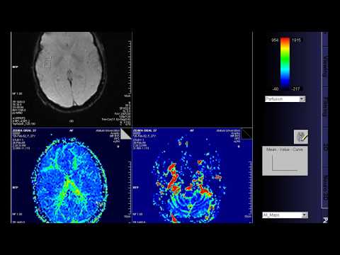 Perfusion MRI