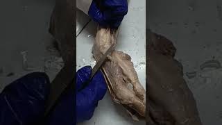 Anatomical snuff box ( show radial artery; it's content)