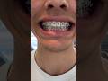 These braces look different🤯