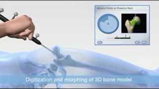 Vector Vision Hip SR