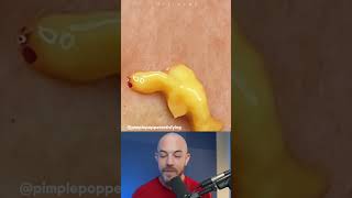 Egg yolk cyst pop! #dermreacts #doctorreacts #yolkpop