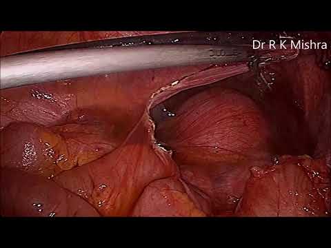 laparoscopic-management-of-peritoneal-inclusion-cyst