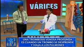 Dr. TV Perú (22052015)  B1  Tema del Día: Várices