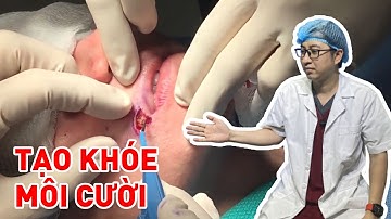 Phẫu thuật tạo khóe môi cười tự nhiên | Bs Mạnh