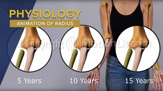 Medical Animation Demonstrates Progression of Migration of Radius Overtime