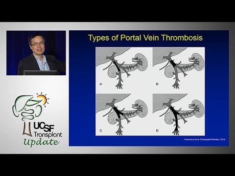 Portal Vein Thrombosis:  Medical and Surgical Consideration - UCSF Liver Transplant Conference 2014