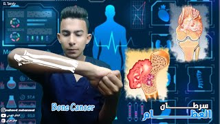 Bone Cancer_سرطـان العظــام