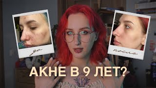 видео: Моя акне история. Как я лечила кожу от прыщей? картинка: Моя акне история. Как я лечила кожу от прыщей?