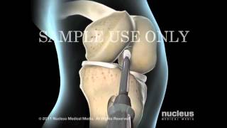 Хирургия коленного сустава - Разрыв передней крестообразной связки