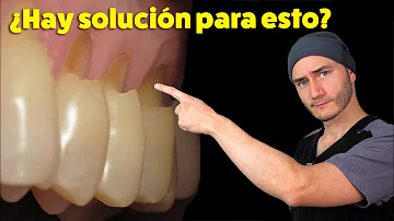 ¿Qué puede hacer un dentista para la pérdida de esmalte?