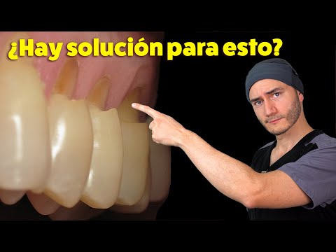 Video: Cómo Saber Cuándo Se Cortan Los Dientes