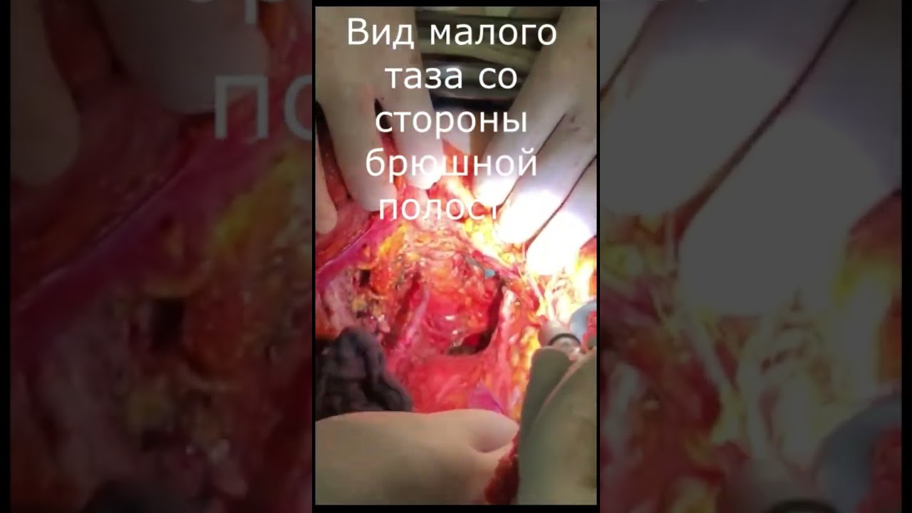 Рецидив рака шейки матки 2b, после химиолучевого лечения