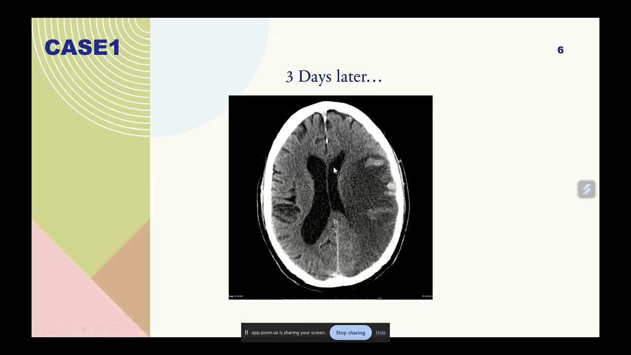 Basic CT and MRI brain and spine น.ต.หญิง จุฑามาศ นพพันธ์ - 17 มิ.ย.2568