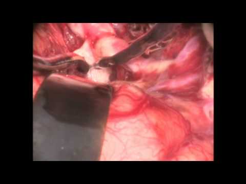 Microsurgical clipping of PCA and ICA bifurcation ...