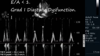 ANTERO-SEPTAL AKINESIS-ECHOCARDIOGRAPHY SERIES BY DR ANKUR K CHAUDHARI.