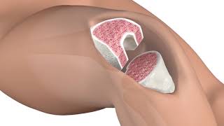 Modern Computer Guided GPS Total Knee Replacement