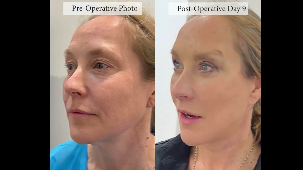 Dr De Silvas Vertical Face Restore VFR Signature Facelift And Neck Lift From Oblique View