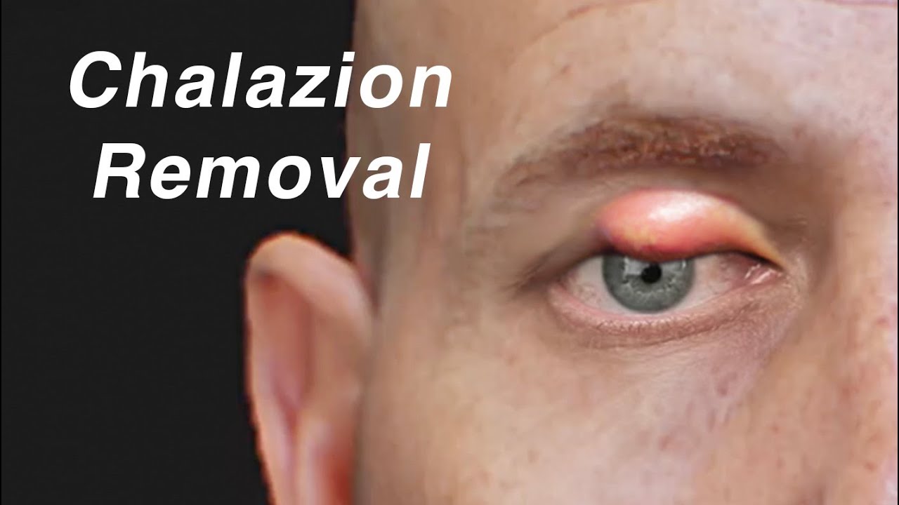 Cataract Eye Surgery Animation - YouTube