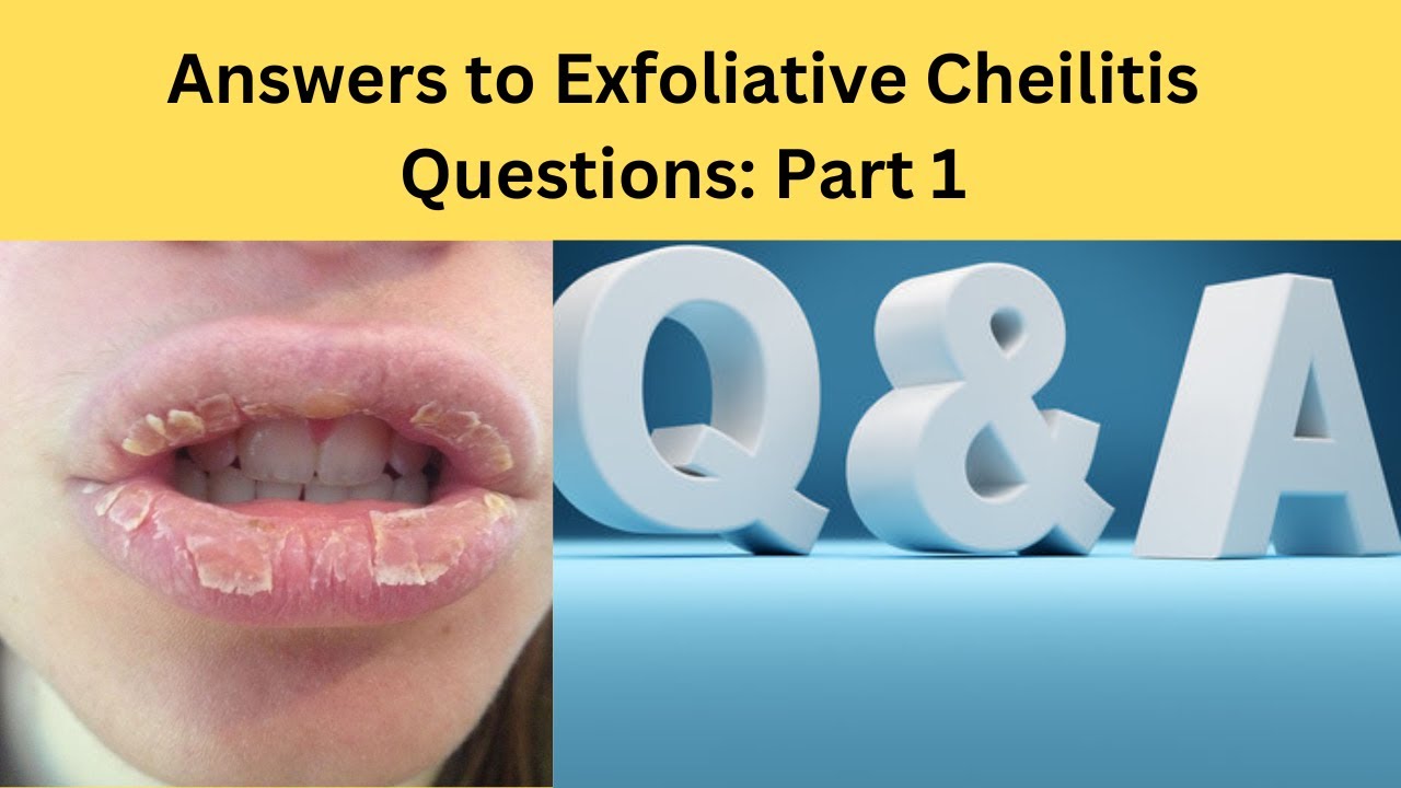 Q & A Exfoliative Cheilitis Answers to Your Questions YouTube