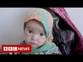 Afghan children battle malnutrition and measles as 23m face extreme hunger - BBC News
