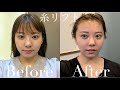 【韓国美容】KR)韓国で糸リフトしたら小顔になった!!