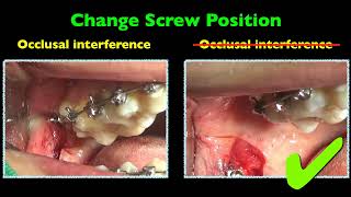 Resolving occlusal interference by ramus screw｜【Chris Chang Ortho】CC689